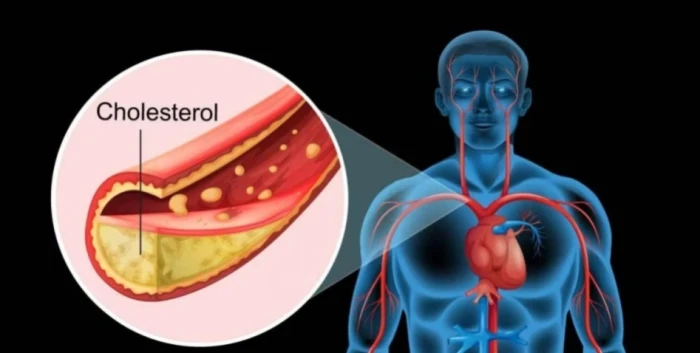 أطعمة ترفع نسبة الكوليسترول الضار في الدم وتزيد خطر الإصابة بالسكتة الدماغية والنوبة القلبية