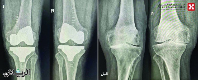 جريدة الرياض | مجمع الدكتور سليمان الحبيب بالعليا يجري عملية ناجحة لاستبدال مفصلي الركبة لـ «ثمانيني» بحالة صحية معقدة