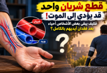 نزيف شرياني وبتر في اليد